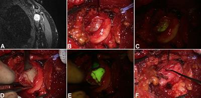 Assessing the role of sodium fluorescein in peripheral nerve sheath tumors and mimicking lesions surgery: An update after 142 cases